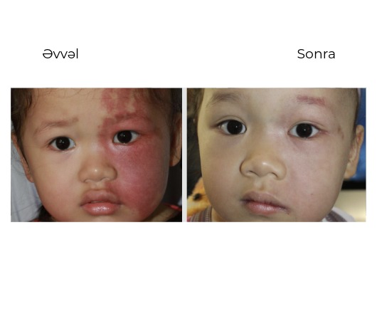 Candela Vbeam Perfecta